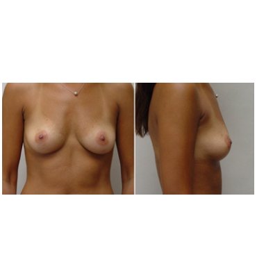 Anatomic Breast Implants Before